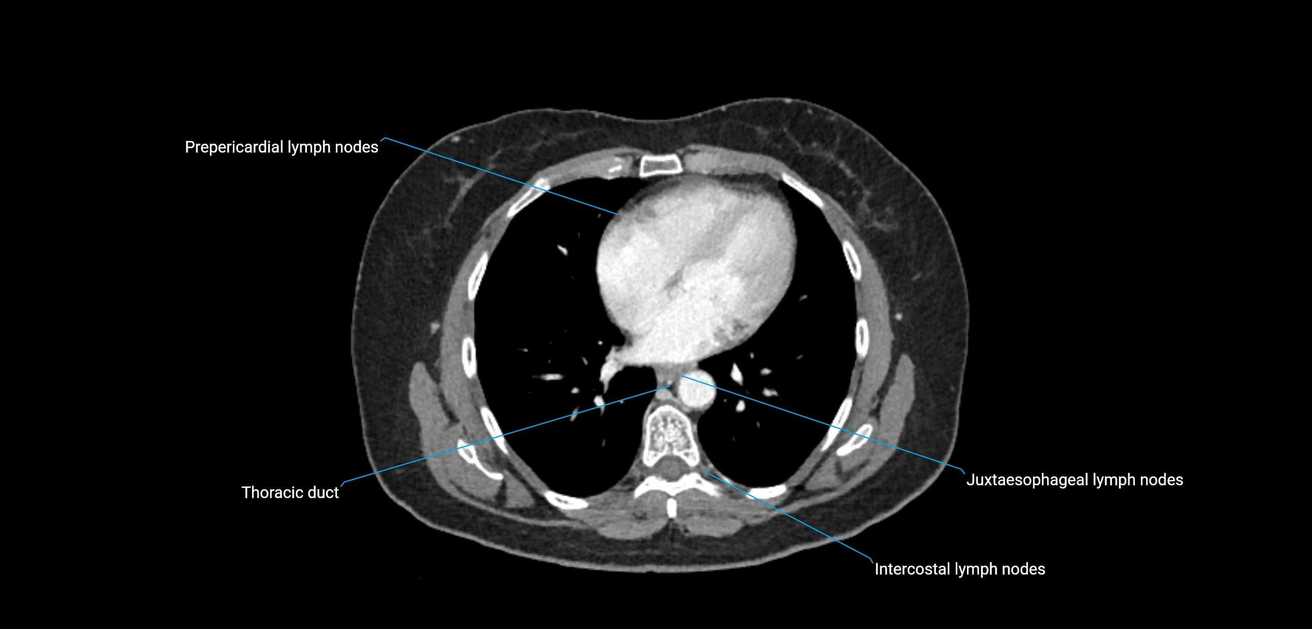 CT ct abdominal lymph nodes  axial cross sectional anatomy  enchanced radiology image -img-00002-00037.webp